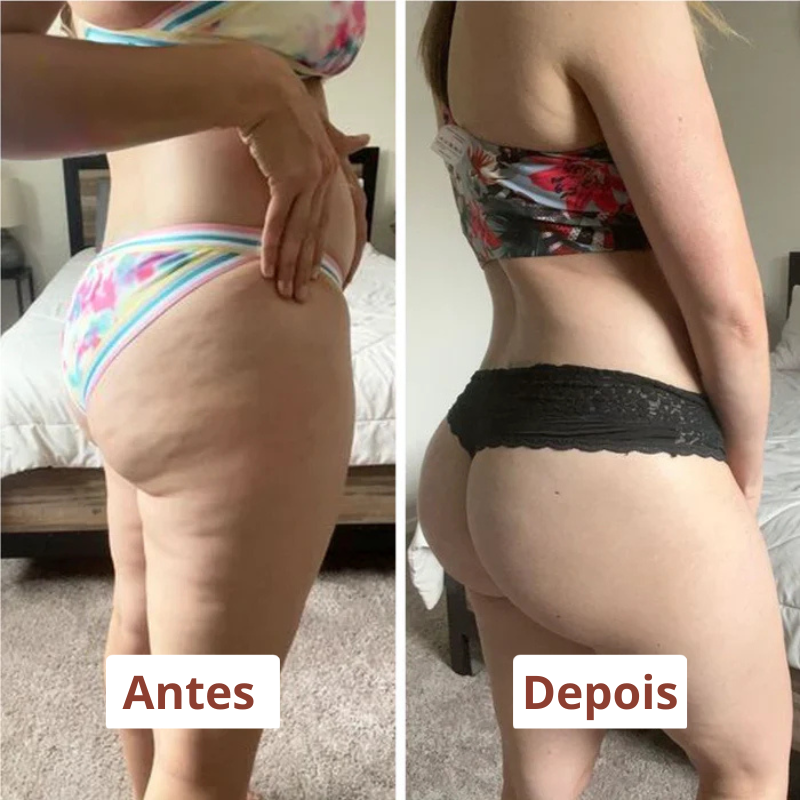 Drena Roller | Massageador linfático para lipedema e celulite