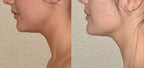DrenaFace – Escova de Drenagem Linfática Facial