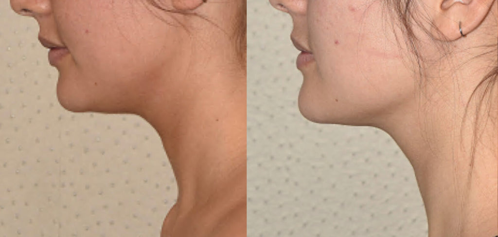 DrenaFace – Escova de Drenagem Linfática Facial